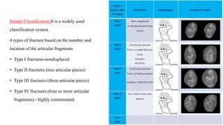 SPORTS INJURIES OF ANKLE AND FOOT original.pptx