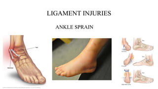 SPORTS INJURIES OF ANKLE AND FOOT original.pptx