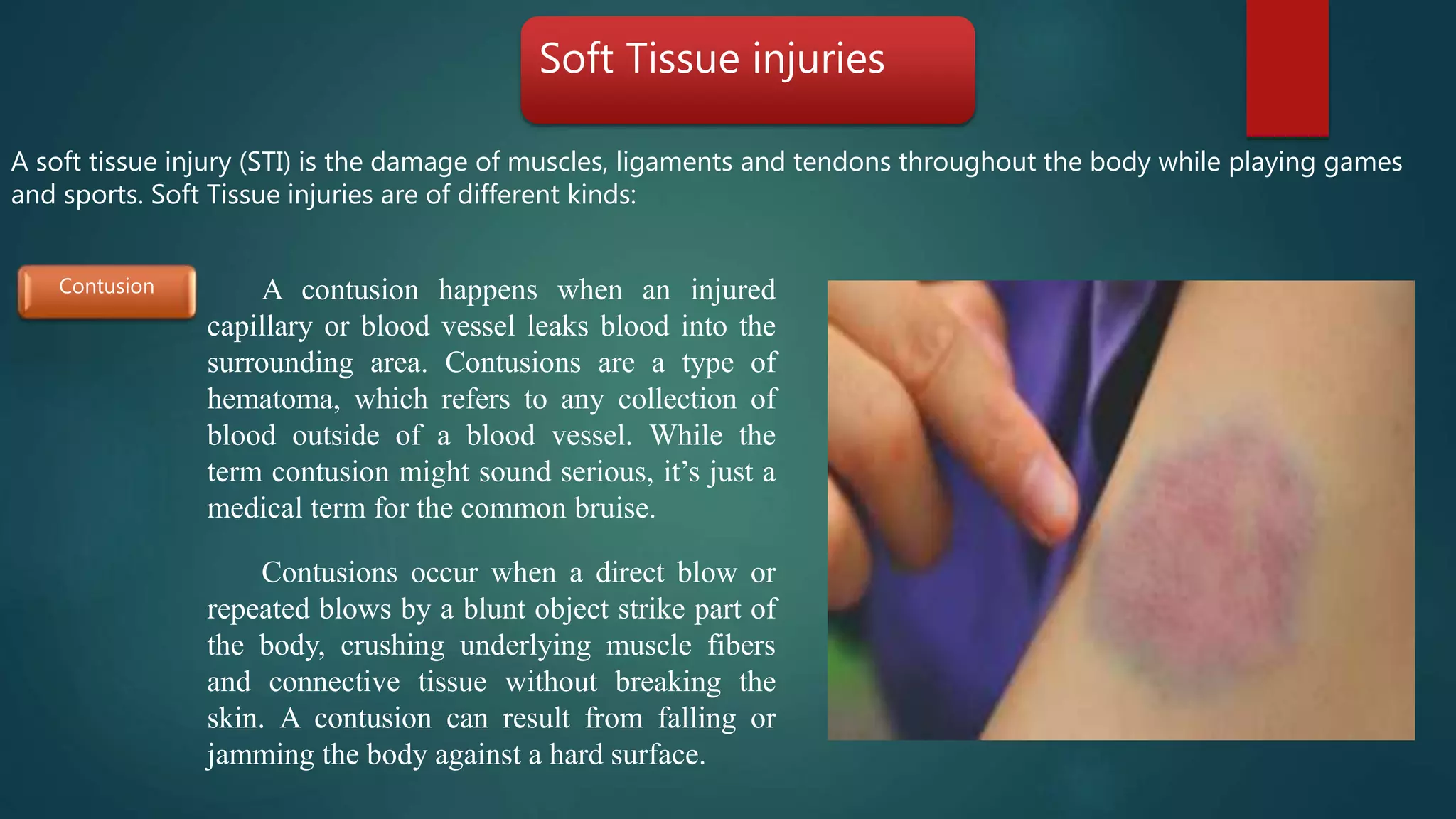 common Sports injuries | PPTX