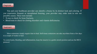 You and your healthcare provider can identify a bruise by its distinct look and coloring. If
you experience frequent or unexplained bruising, your provider may order tests to rule out
possible causes. These tests include:
• X-rays to check for bone fractures.
• Blood tests to check for clotting disorders and vitamin deficiencies.
Most contusions simply require time to heal. Soft tissue contusions can take anywhere from a few days
to a couple of weeks to heal.
To control pain, bleeding, and inflammation, keep the muscle in a gentle stretch position and use the RICE
protocol:
Diagnose
Treatment
 
