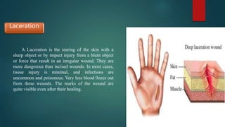 Laceration
A Laceration is the tearing of the skin with a
sharp object or by impact injury from a blunt object
or force that result in an irregular wound. They are
more dangerous than incised wounds. In most cases,
tissue injury is minimal, and infections are
uncommon and poisonous. Very less blood 0ozes out
from these wounds. The marks of the wound are
quite visible even after their healing.
 