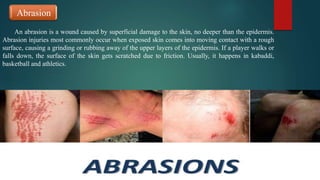 Abrasion
An abrasion is a wound caused by superficial damage to the skin, no deeper than the epidermis.
Abrasion injuries most commonly occur when exposed skin comes into moving contact with a rough
surface, causing a grinding or rubbing away of the upper layers of the epidermis. If a player walks or
falls down, the surface of the skin gets scratched due to friction. Usually, it happens in kabaddi,
basketball and athletics.
 