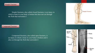 Simple Fracture
Simple fractures, also called closed fractures, is an injury in
which a bone in your body is broken but does not cut through
the flesh that surrounds it
Compound Fracture
Compound fractures, also called open fractures, is
an injury in which a bone in your body is broken and it
also cut through the flesh that surrounds it
 