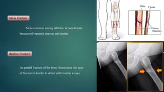 Stress Fracture
Hairline Fracture
More common among athletes. A bone breaks
because of repeated stresses and strains.
Aa partial fracture of the bone. Sometimes this type
of fracture is harder to detect with routine x-rays.
 
