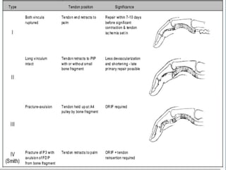 Finger Devascularization Sports related injuries to hand sagar | PPTX