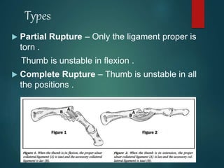 Sl Partial Rupture Sports related injuries to hand sagar | PPTX