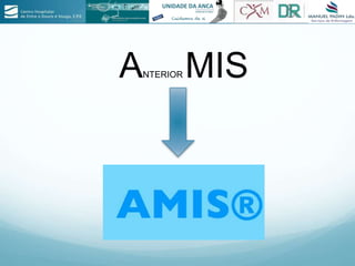 ANTERIOR MIS
 