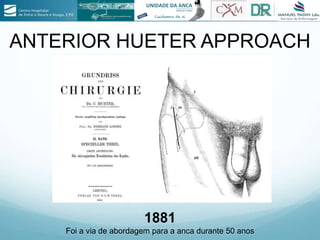 ANTERIOR HUETER APPROACH
1881
Foi a via de abordagem para a anca durante 50 anos
 