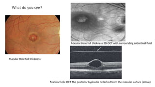 Macular Roth Spot Spot Diagnosis - Look at the pictures-What do you See - Acquired ...