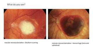 Disciform Macula Spot Diagnosis - Look at the pictures-What do you See - Acquired ...