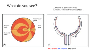 Red Periphery Spot Diagnosis - Look at the pictures-What do you See - Glaucoma.pptx