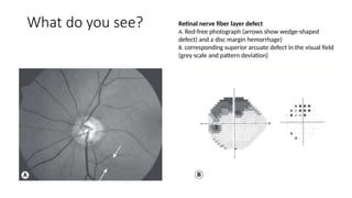 Grey Scale Defect Spot Diagnosis - Look at the pictures-What do you See - Glaucoma.pptx