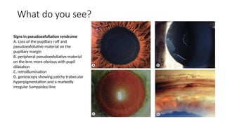 Pupillary Ruff Loss Spot Diagnosis - Look at the pictures-What do you See - Glaucoma.pptx
