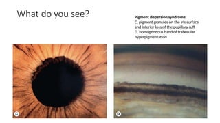 Spot Diagnosis - Look at the pictures-What do you See - Glaucoma.pptx