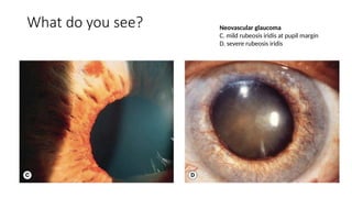 Spot Diagnosis - Look at the pictures-What do you See - Glaucoma.pptx