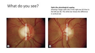 Spot Diagnosis - Look at the pictures-What do you See - Glaucoma.pptx