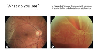 Retinal Detachment Rosh Spot Diagnosis - Look at the pictures-What do you See - Retinal ...