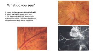 Nvd Optometry Spot Diagnosis - Look at the pictures-What do you See - Retinal Vascula ...