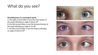 Hirschberg Examples Spot Diagnosis - Look at the pictures-What do you See - Strabismus.pptx