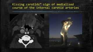 Kissing carotids” sign of medialised
course of the internal carotid arteries
 