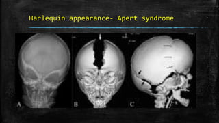 Harlequin appearance- Apert syndrome
 