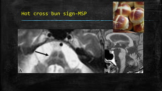 Hot cross bun sign-MSP
 