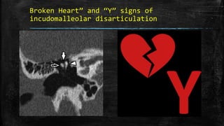 Broken Heart” and “Y” signs of
incudomalleolar disarticulation
 
