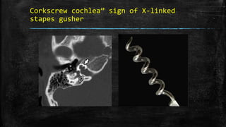 Corkscrew cochlea” sign of X-linked
stapes gusher
 