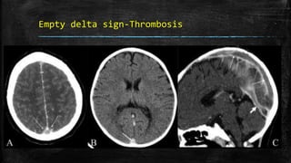 Empty delta sign-Thrombosis
 