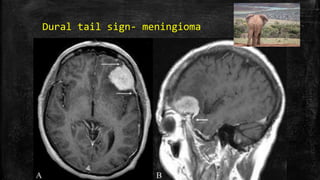 Dural tail sign- meningioma
 