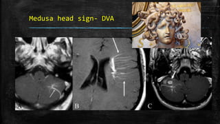 Medusa head sign- DVA
 