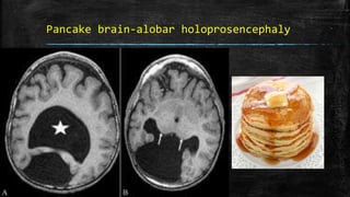Pancake brain-alobar holoprosencephaly
 