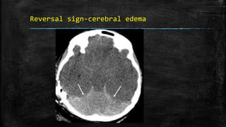 Reversal sign-cerebral edema
 