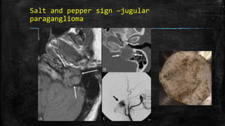 Salt and pepper sign –jugular
paraganglioma
 
