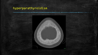 hyperparathyroidism
 