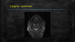 Sjögren syndrome
 