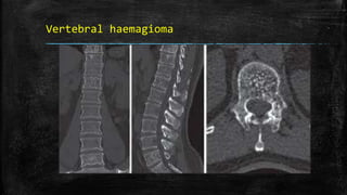 Vertebral haemagioma
 