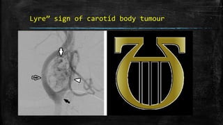 Lyre” sign of carotid body tumour
 