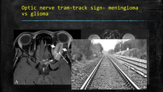 Optic nerve tram-track sign- meningioma
vs glioma
 