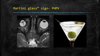 Martini glass” sign- PHPV
 