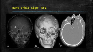 Bare orbit sign- NF1
 
