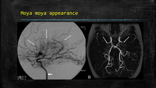 Moya moya appearance
 