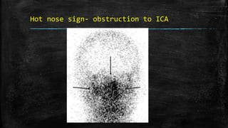 Hot nose sign- obstruction to ICA
 