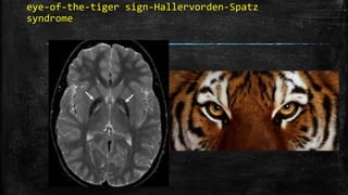 eye-of-the-tiger sign-Hallervorden-Spatz
syndrome
 