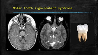 Molar tooth sign-Joubert syndrome
 