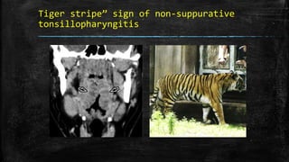 Tiger stripe” sign of non-suppurative
tonsillopharyngitis
 