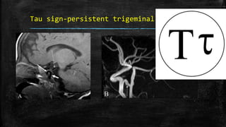 Tau sign-persistent trigeminal artery
 