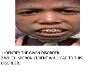 1.IDENTIFY THE GIVEN DISORDER.
2.WHICH MICRONUTRIENT WILL LEAD TO THIS
DISORDER.
 