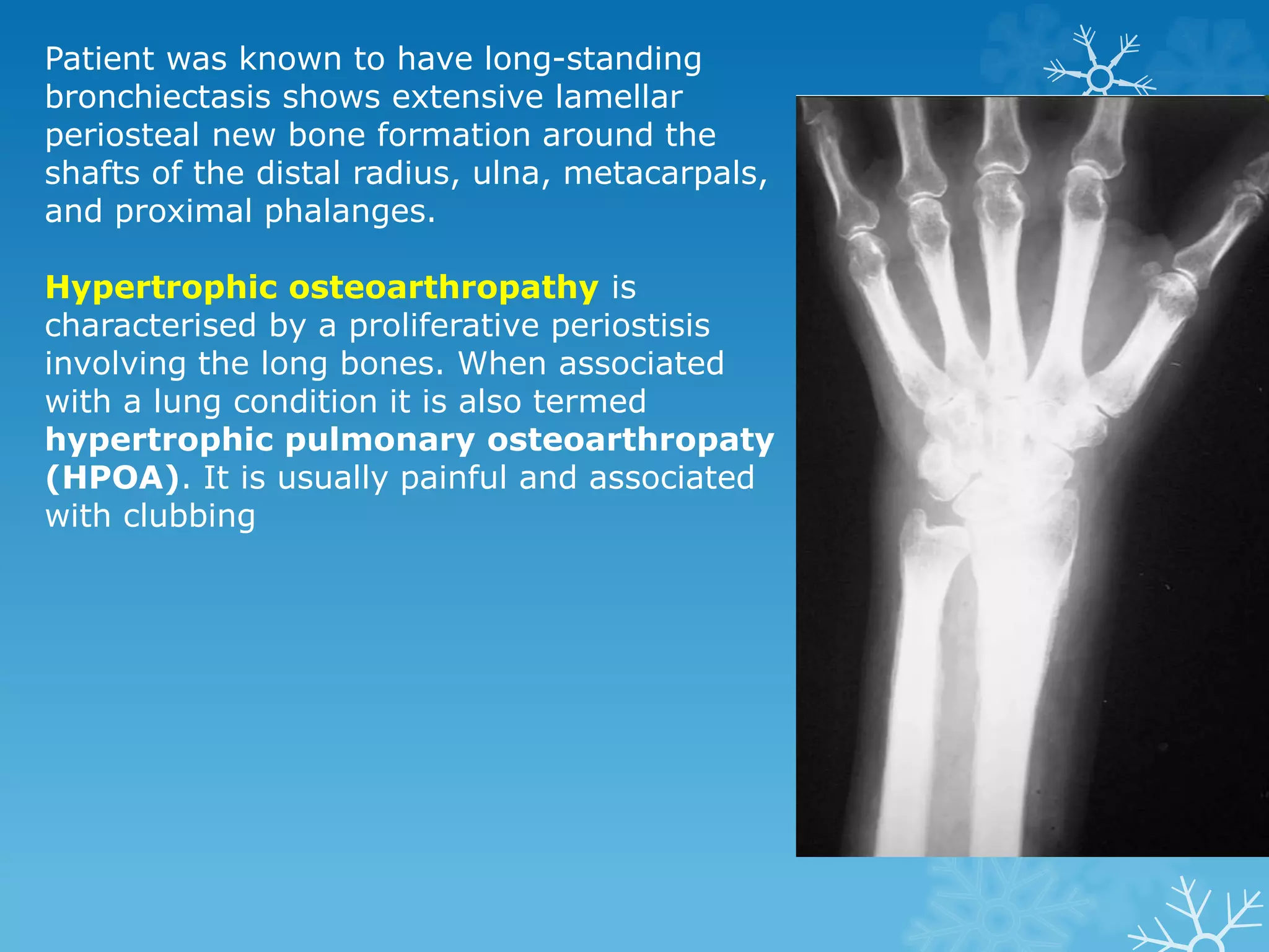 Patient was known to have long-standing
bronchiectasis shows extensive lamellar
periosteal new bone formation around the
shafts of the distal radius, ulna, metacarpals,
and proximal phalanges.
Hypertrophic osteoarthropathy is
characterised by a proliferative periostisis
involving the long bones. When associated
with a lung condition it is also termed
hypertrophic pulmonary osteoarthropaty
(HPOA). It is usually painful and associated
with clubbing
 