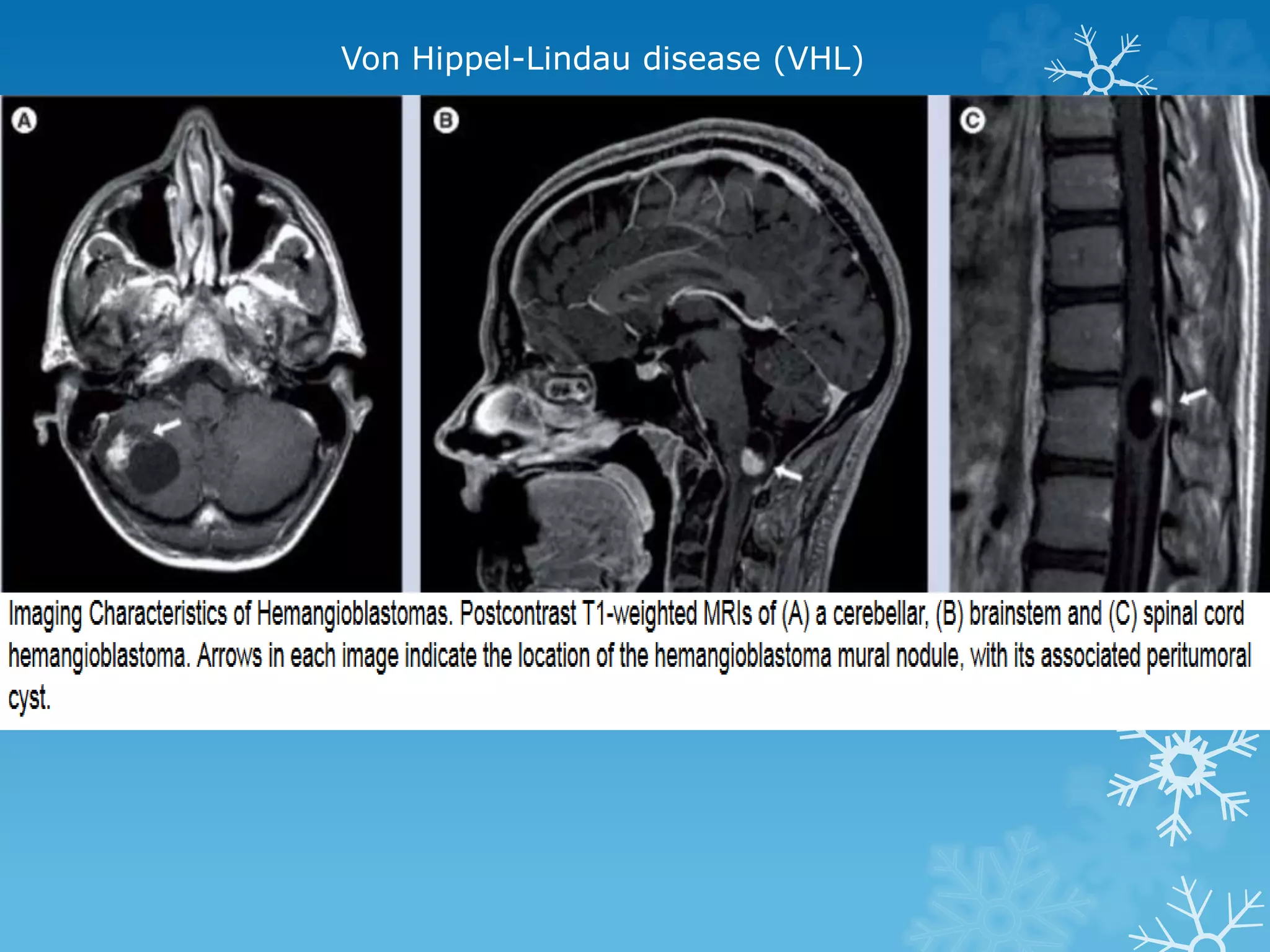 Von Hippel-Lindau disease (VHL)
 